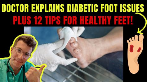 Doctor Explains Diabetic Foot Complications Plus 12 Tips For Prevention Youtube