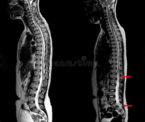 X-ray C-Spine Lateral Normal Views and Post Operation Spinal Fixcation ...