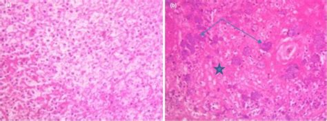 In The Peri Adrenal Stroma There Were Mixed Inflammatory Cells A