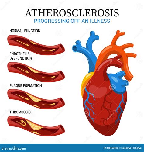 Atherosclerosis Stages Anatomy Of Heart Attack Arteriosclerotic