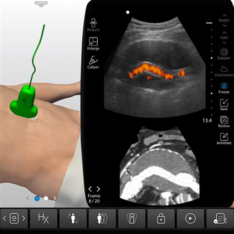 Ultrasound Training - Aorta and Inferior Vena Cava (IVC)