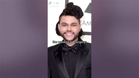 The Weeknd’s Plastic Surgery Before And After Must Watch Tiktok Edition 😭‼️ Read