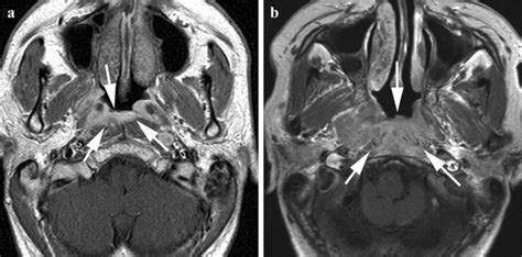 Patients with NPC spread to the prevertebral space (PVS+). Patient with ...