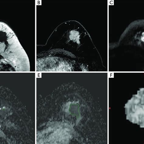 Images From A 49 Year Old Female Patient With Invasive Ductal Carcinoma