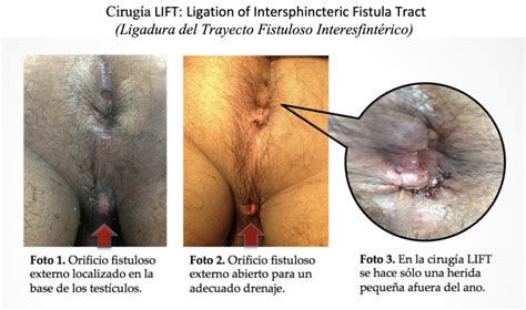 Fístula Anal Coloclinic