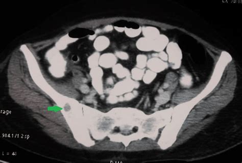 transverse section  ct pelvis showing lytic lesions  iliac bone