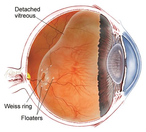 Vitrectomy For Floaters Retina Specialists Of North Alabama LLC