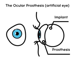 Evisceration - Prosthetic Eye Surgery - Smart Laser Eye Center