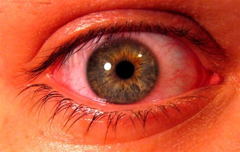 Conjunctival Injection Flickr Photo Sharing