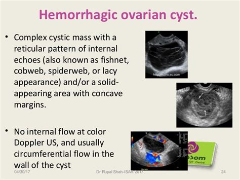 Management Of Ovarian Cysts Other Than Endometriomas In Infertility