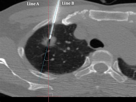 Ct Guided Percutaneous Core Needle Biopsy For Lung Lesions A 14 Year