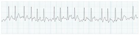 Atrial Fibrillation - Causes, Symptoms, Treatments, and Diagnosis