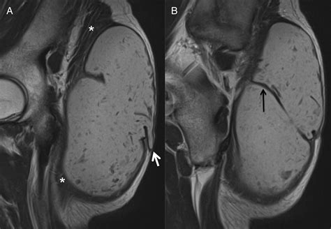 Giant Epidermal Cyst With Intramuscular Extension A Rare Occurrence