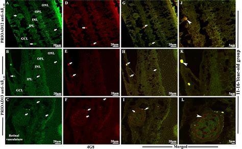 A Sequential Deposition Of Amyloid Beta Oligomers Plaques And