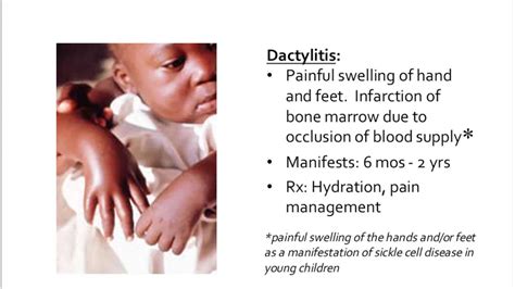 Sickle Cell Anemia Symptoms