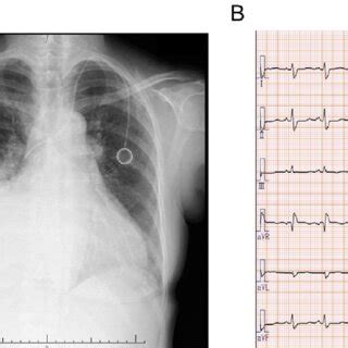 Figure1.(A) Chest X-ray at admission showing lung congestion with ...