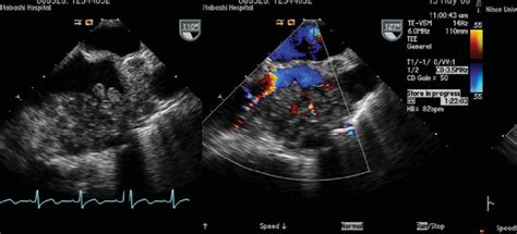 Transesophageal Echocardiography Tee On The Second Admission Tee Download Scientific Diagram