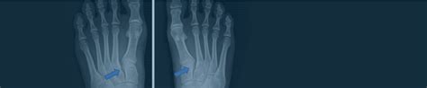 Lisfranc Fracture - Dr Warren