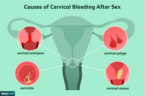 Postcoital Bleeding Bleeding After Sex What Causes It