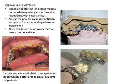 REHABILITACIÓN II: Selección y colocación de dientes artificiales y ...