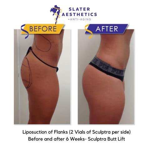 Brazilian Butt Lift Sculptra Butt Lift Results Dr Monte Slater