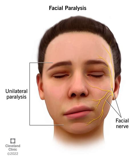 Facial Paralysis Causes Symptoms Treatment