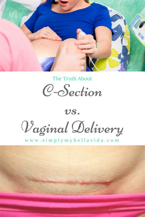 What To Expect When Having A C Section Artofit