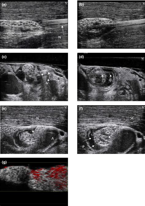 Novel approaches to needle tracking and visualisation - McLeod - 2021