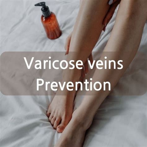 Varicose Veins Causes Symptoms And Treatment 실용적인 건강 팁