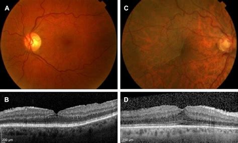 Epiretinal Membrane Fundus Photo