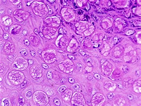 Pathology Outlines Molluscum Contagiosum