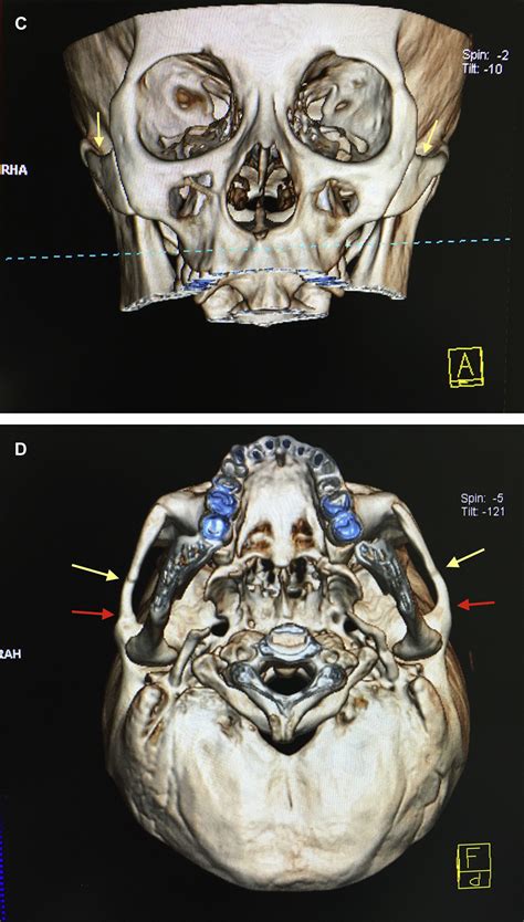 A Novel Technique For Reduction Malarplasty By Inward Displacement Of