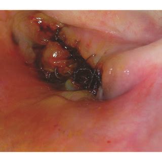 A Preoperative Clinical View B Sutures C Postoperative View