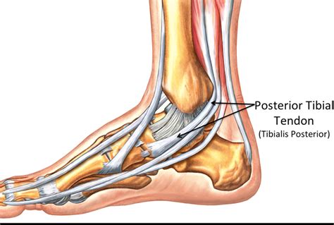 Posterior Tibial Tendon Dysfunction The Movement Centre The Best Porn