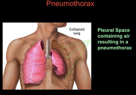 Pneumothorax Exam Flashcards Quizlet