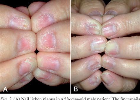 Lichen Planus Of Nail Semantic Scholar