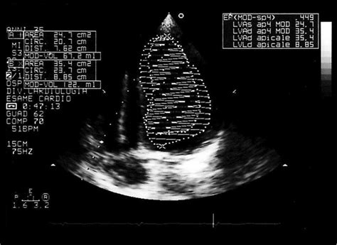 Echocardiogram Showing Lvef 45 At 1 Month Follow Up After Ivabradine