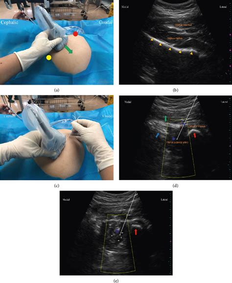 Bilateral Pudendal Nerve Block