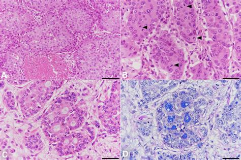 SciELO Brasil Hepatoid Adenocarcinoma Of The Lung Mimicking