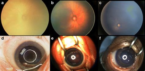 Fundus pigmentation grading system: a blonde fundus b medium fundus and ...