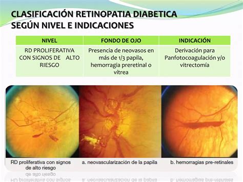 retinopatia diabética retinopatía hipertensiva PPT