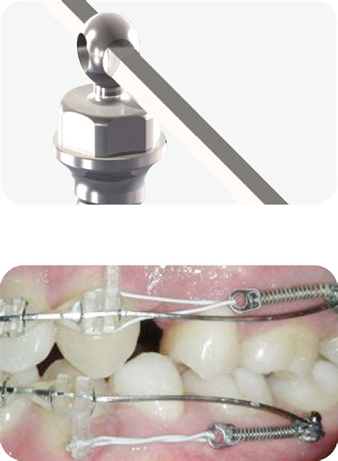 Mini Implant Dentaire Vis Dualtop Jo Type Jeil Medical