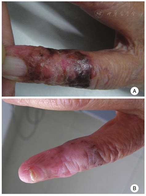 Bowens Disease On The Left Fifth Finger Successfully Treated With