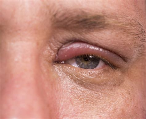 Swollen Eyelids Causes Treatments And More 58 Off