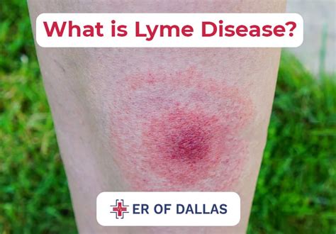 Lyme Disease Symptoms Treatment And Home Remedies Er Of Dallas