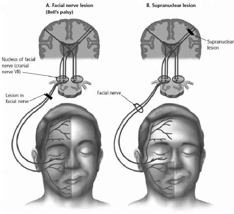 Patients With A A Facial Nerve Lesion And B A Supranuclear Lesion