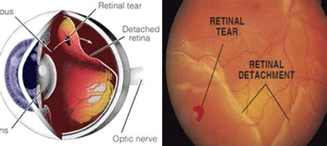 Torn Retina / Ophthalmoscopy View Of Torn Retina In Eye Photograph by ...