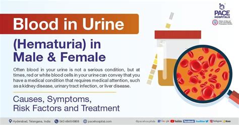 Understanding Hematuria: Causes, Symptoms, And Treatment - Ask The ...