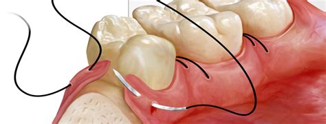 Curso de Periodoncia avanzada cirugía regenerativa periodontal y