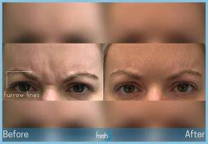 Cosmetic Injectables Nw Calgary Fresh Laser Skin Studio